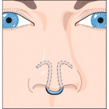 Dilatateur nasal Clip Air