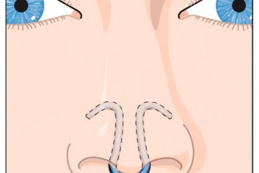 Dilatateur nasal Clip Air